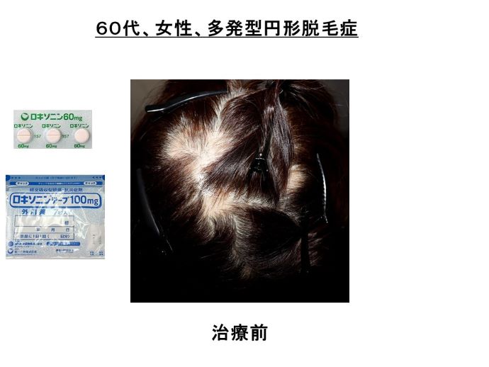 円形脱毛症　病院